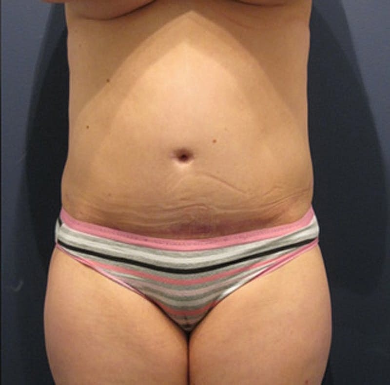 Tummy Tuck Before & After