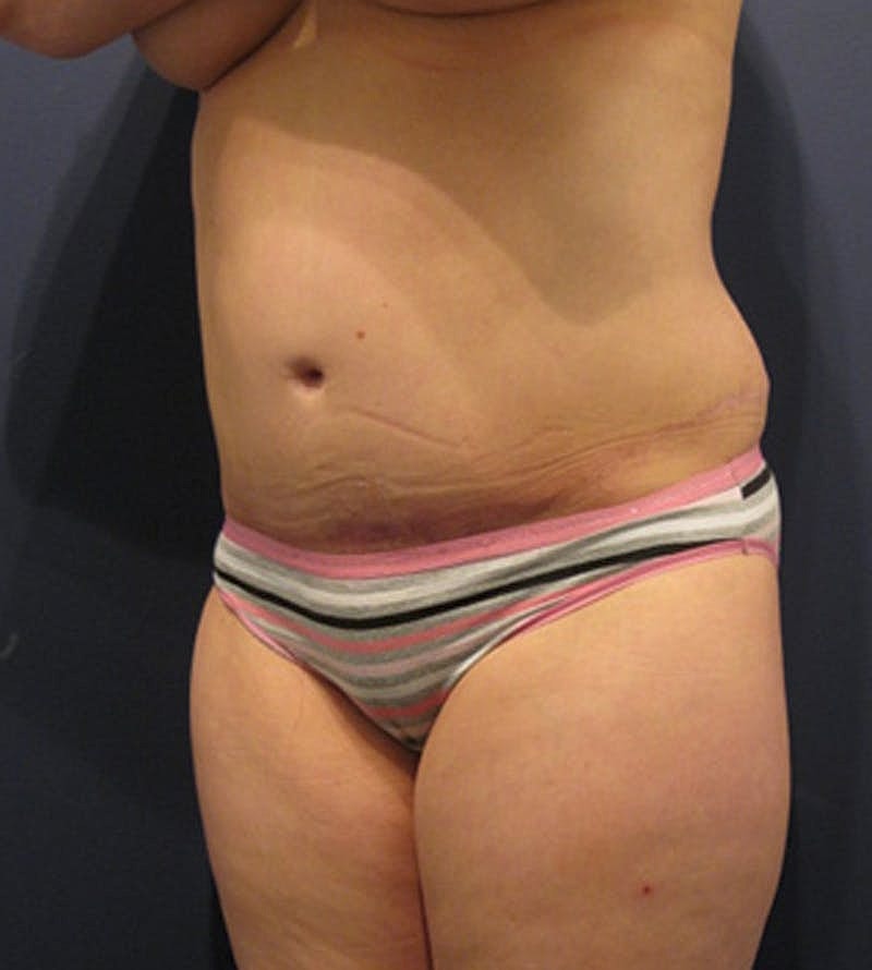 Tummy Tuck Before & After