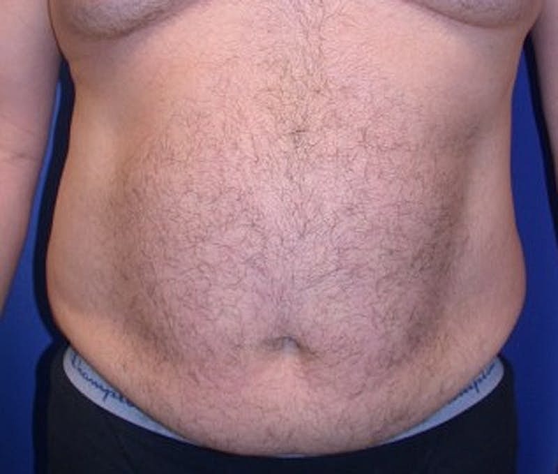 Tummy Tuck Before & After