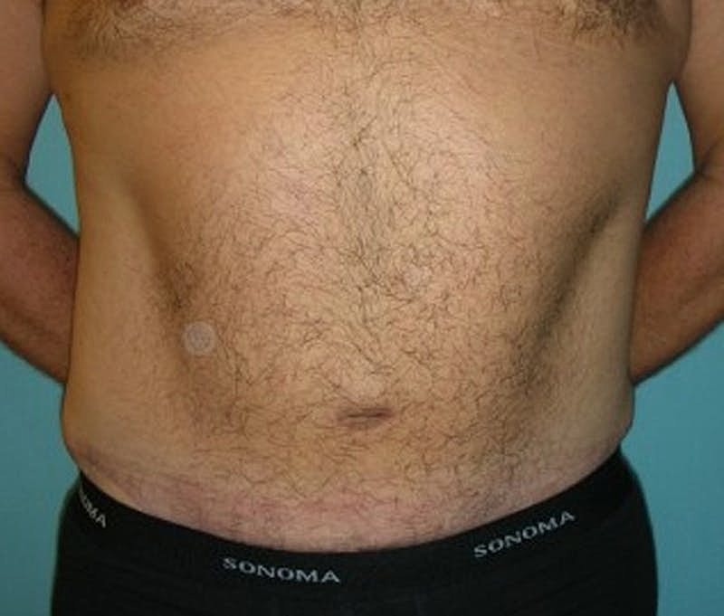 Tummy Tuck Before & After