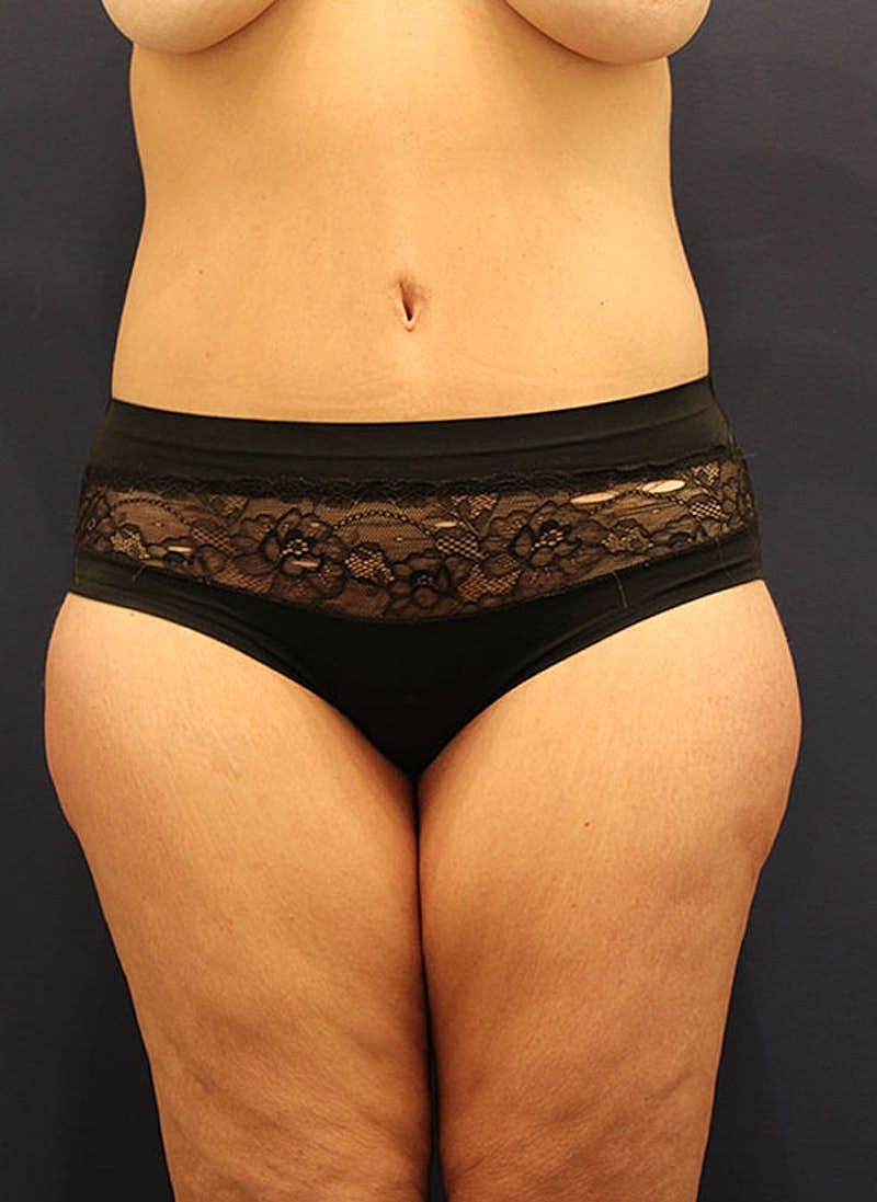 Tummy Tuck Before & After