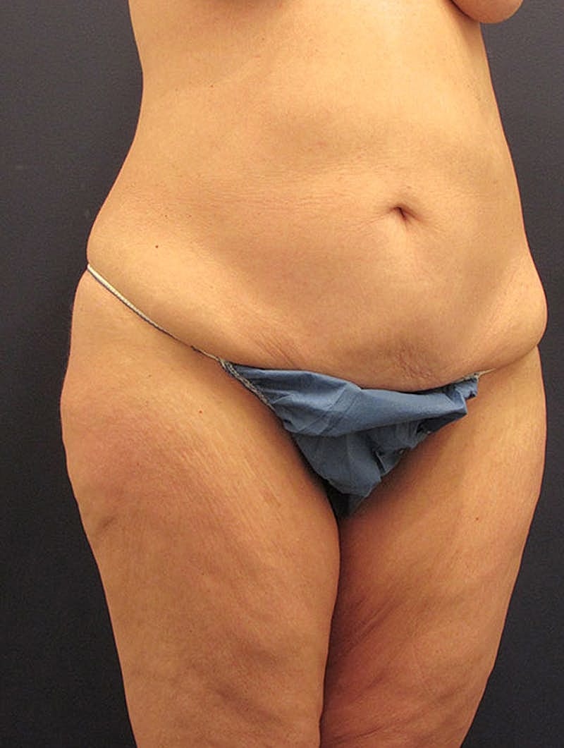 Tummy Tuck Before & After