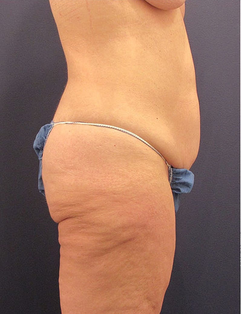 Tummy Tuck Before & After