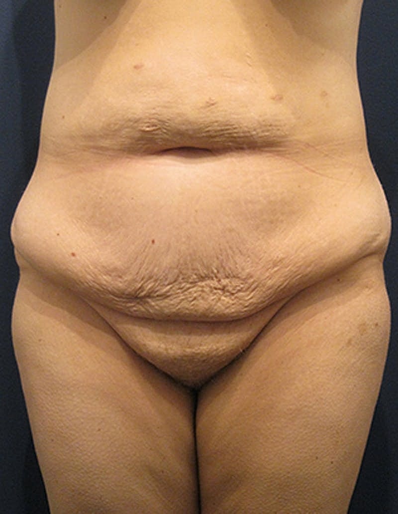 Tummy Tuck Before & After