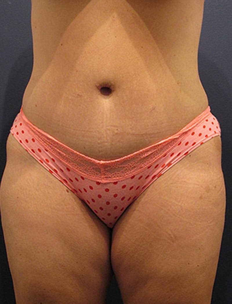 Tummy Tuck Before & After