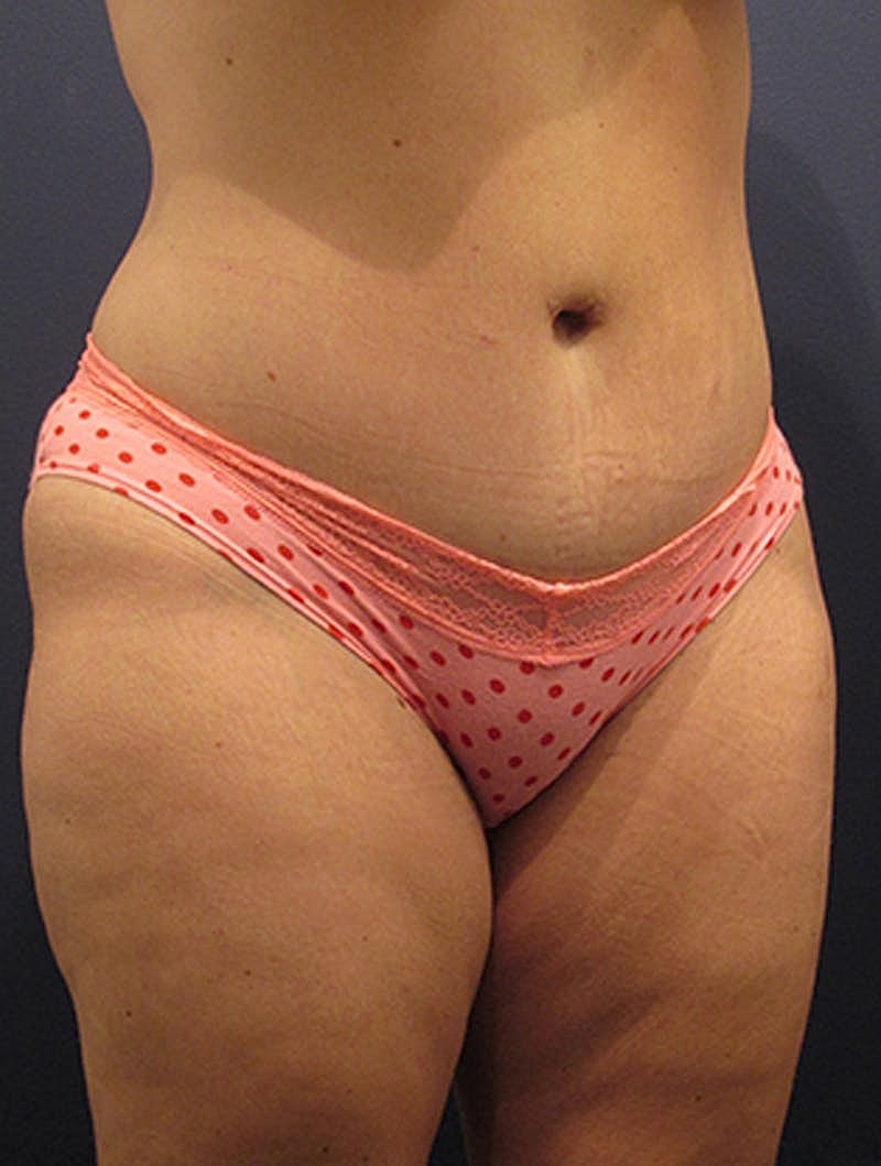 Tummy Tuck Before & After