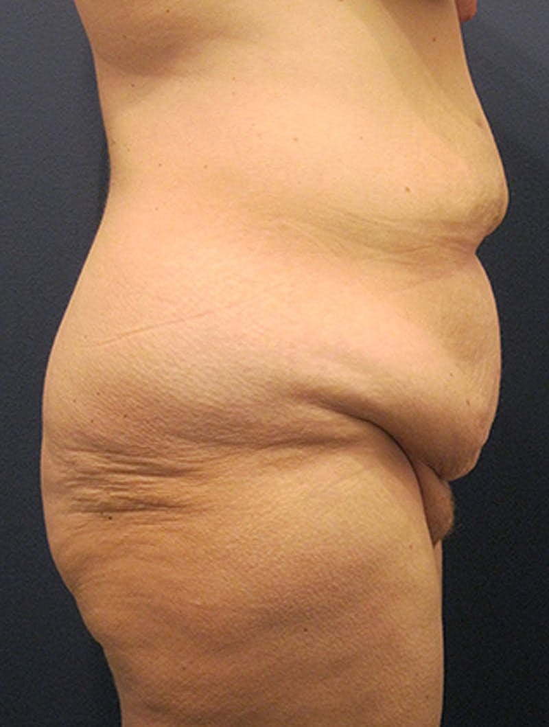 Tummy Tuck Before & After