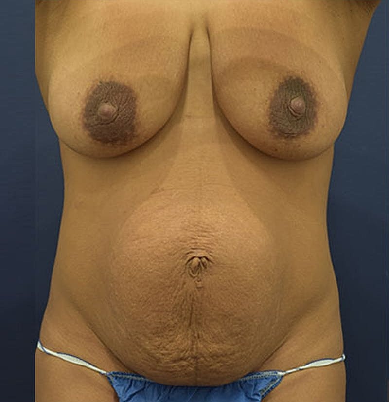 Tummy Tuck Before & After