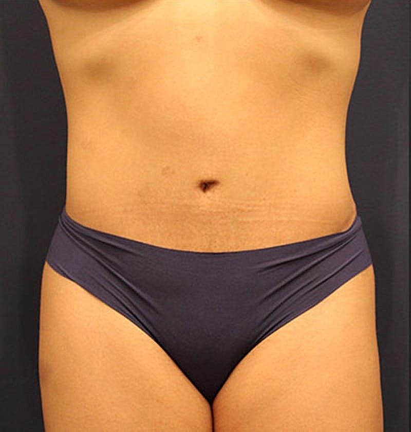 Tummy Tuck Before & After