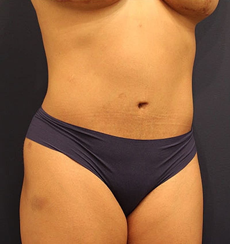 Tummy Tuck Before & After