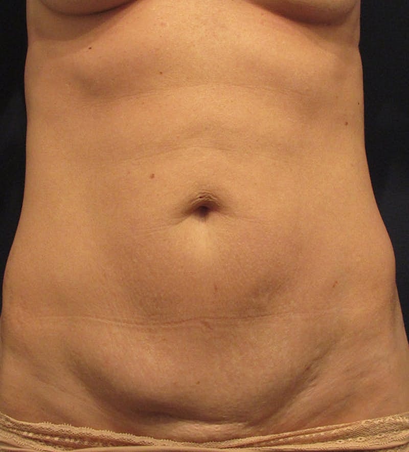 Tummy Tuck Before & After