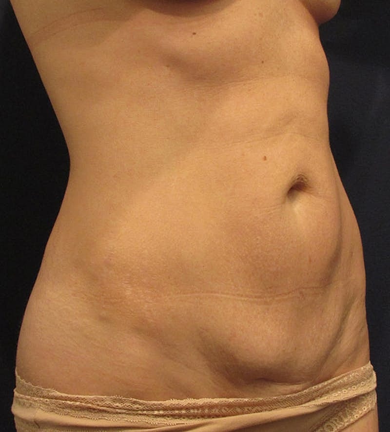 Tummy Tuck Before & After