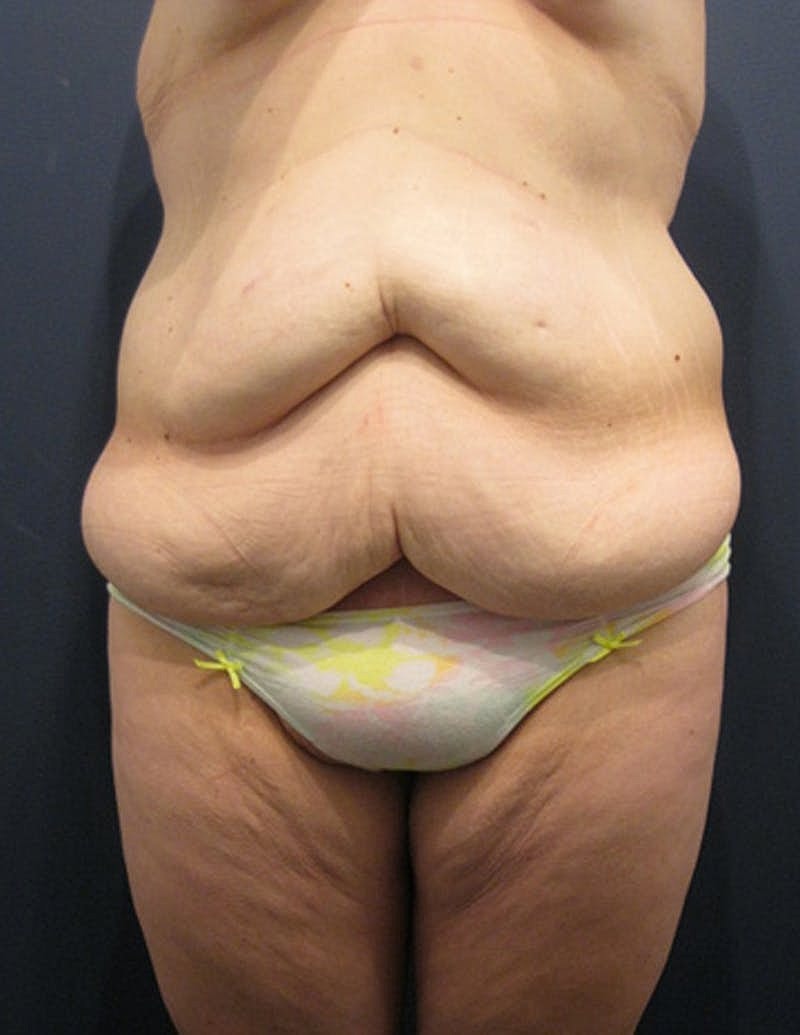 Tummy Tuck Before & After