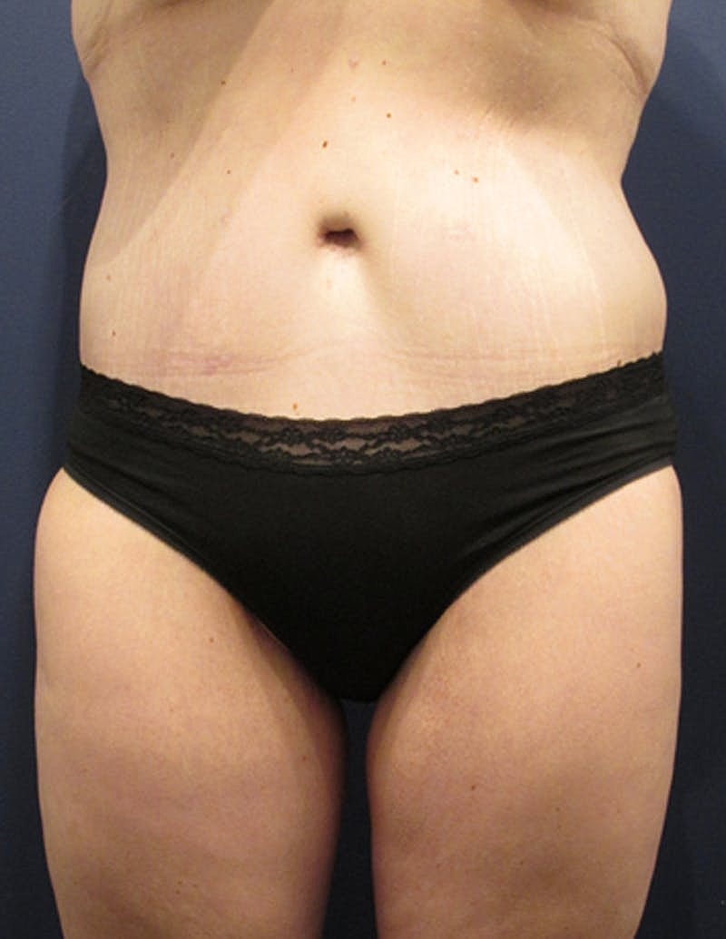 Tummy Tuck Before & After
