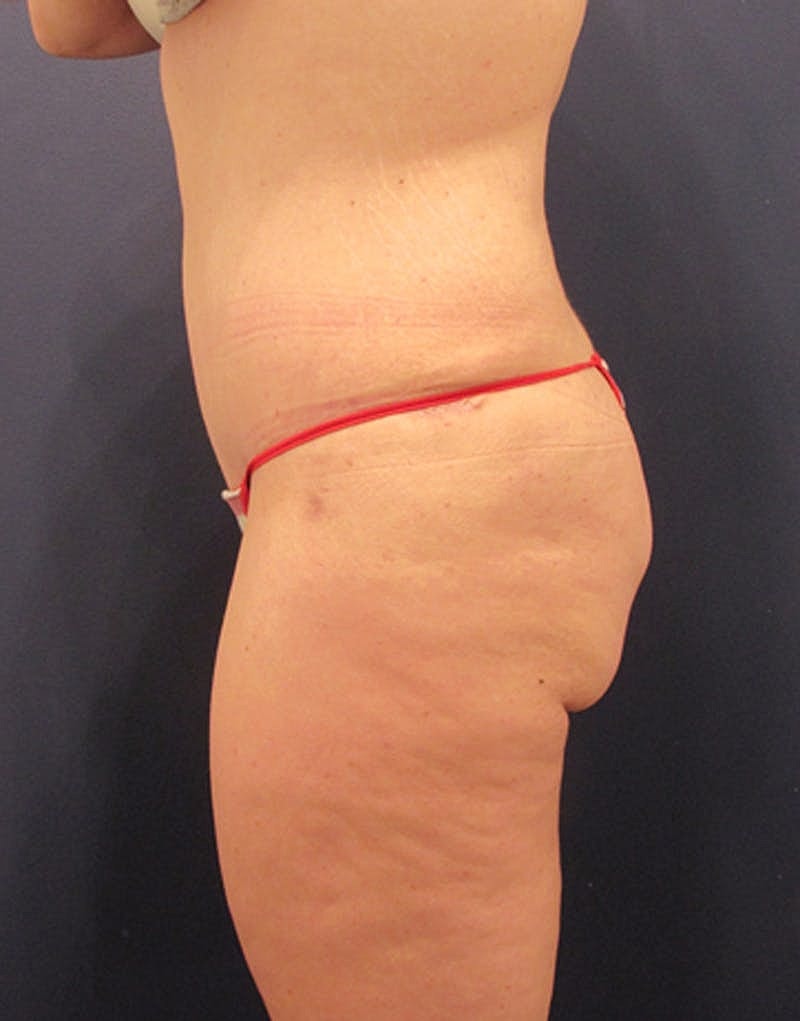 Tummy Tuck Before & After