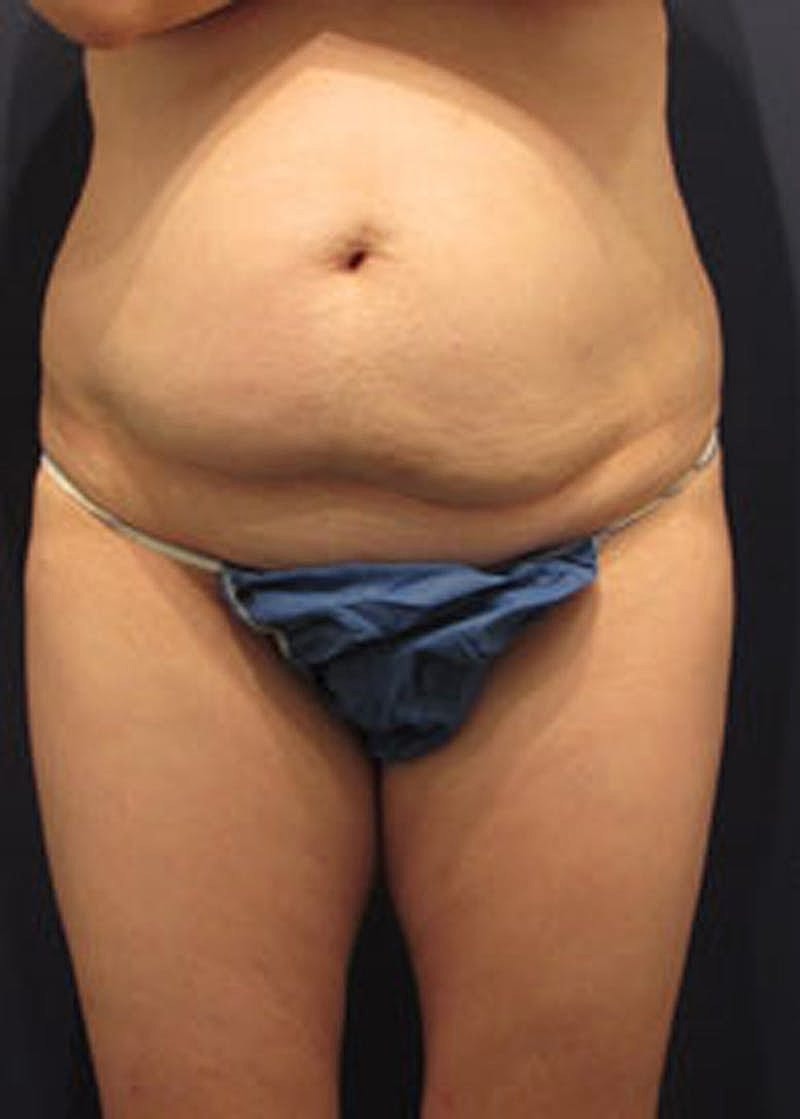 Tummy Tuck Before & After