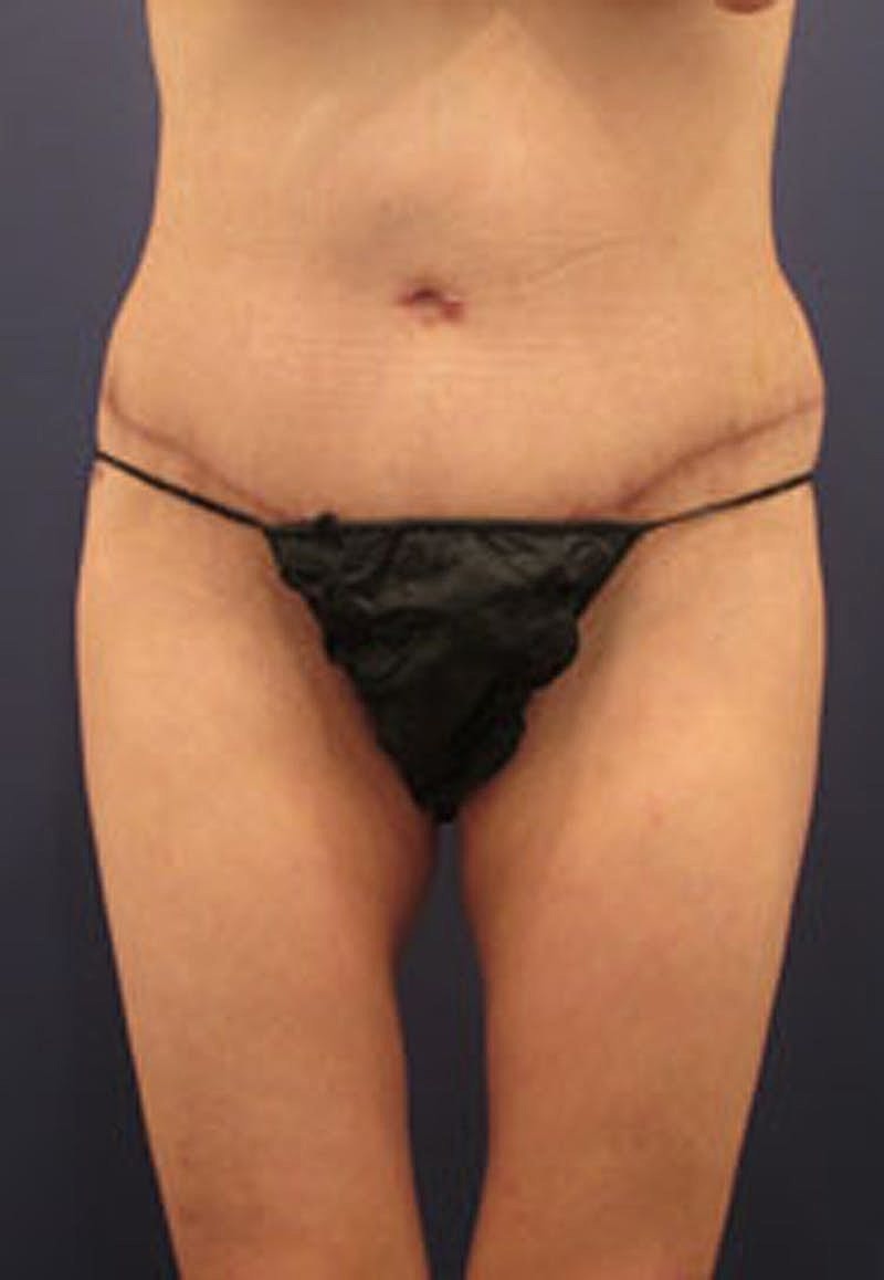 Tummy Tuck Before & After