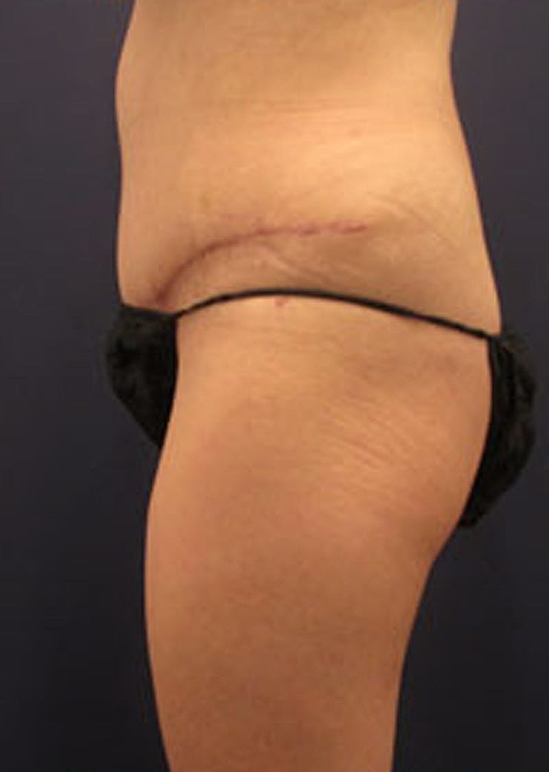 Tummy Tuck Before & After