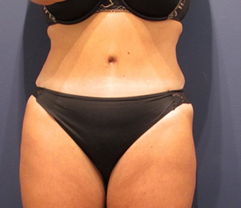 Tummy Tuck Before & After
