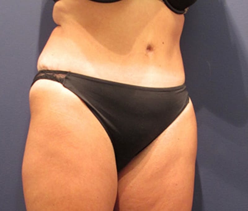 Tummy Tuck Before & After