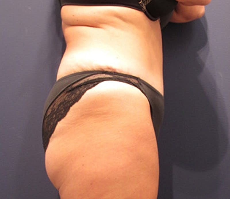 Tummy Tuck Before & After