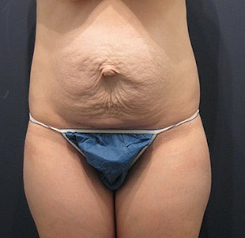 Tummy Tuck Before & After