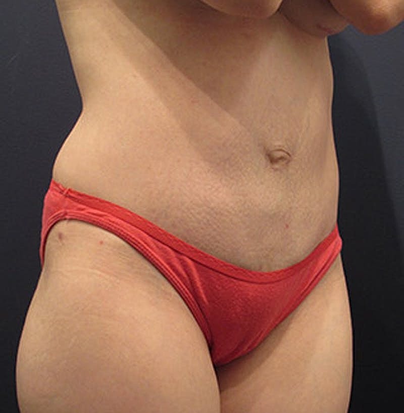 Tummy Tuck Before & After