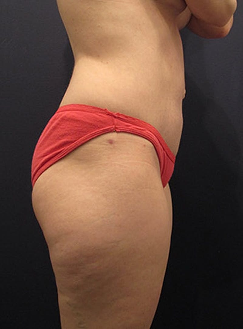 Tummy Tuck Before & After