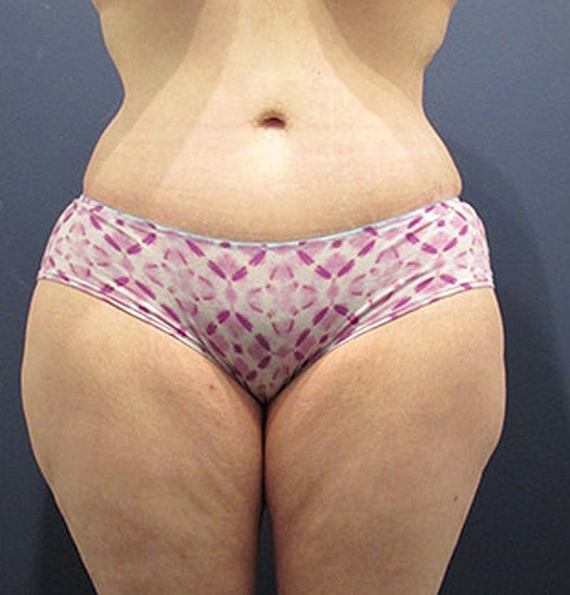 Tummy Tuck Before & After