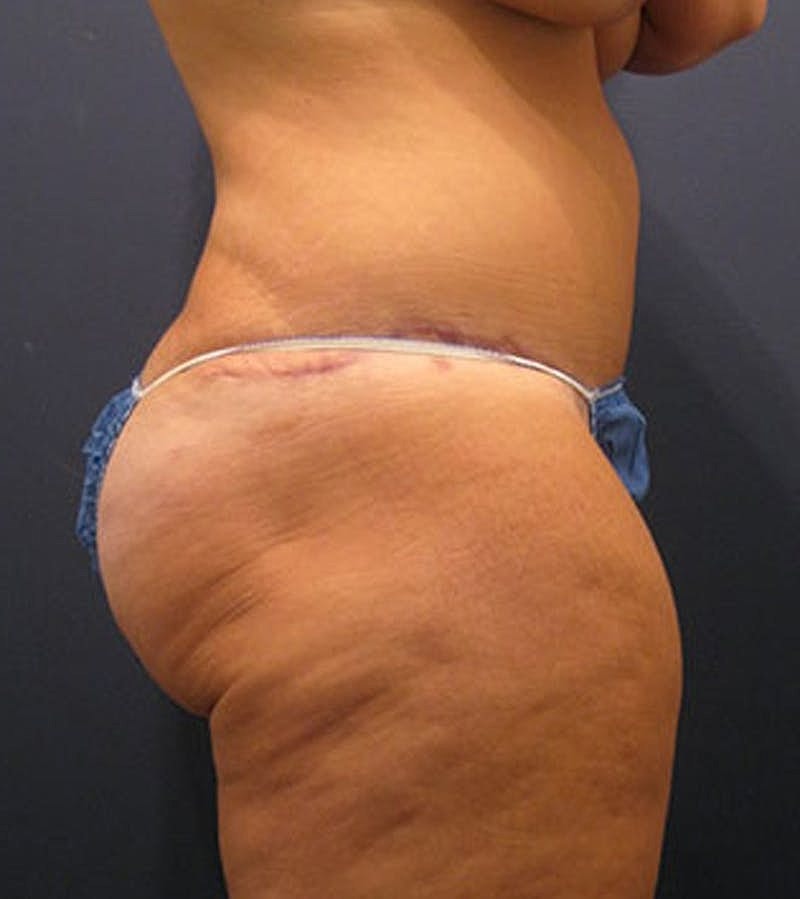Tummy Tuck Before & After