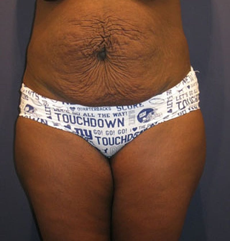 Tummy Tuck Before & After
