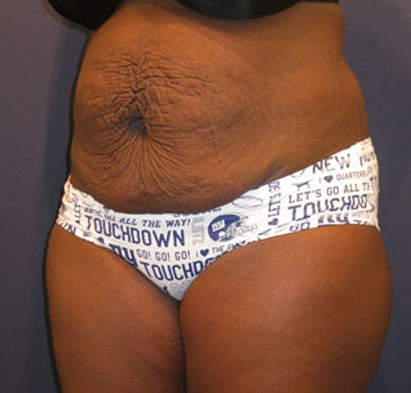 Tummy Tuck Before & After