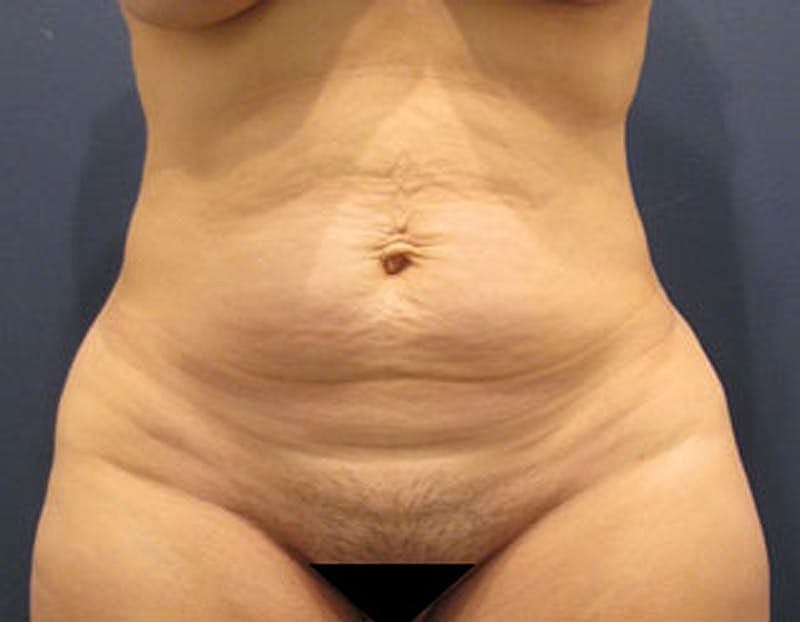 Tummy Tuck Before & After
