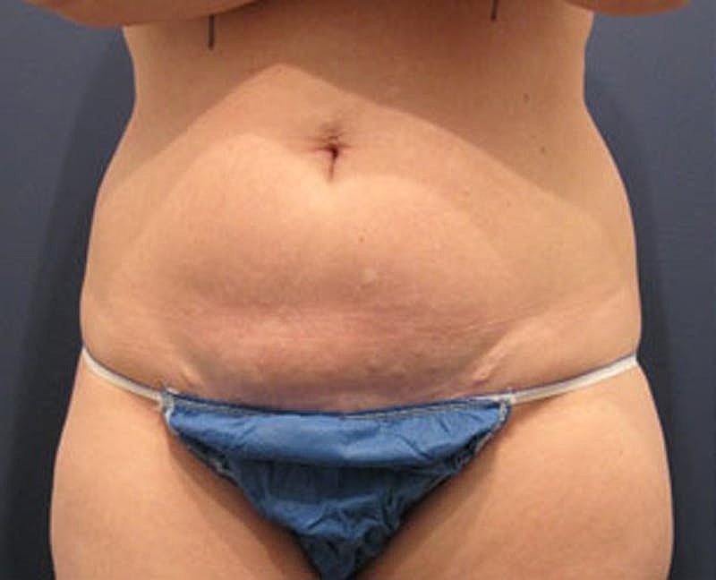 Tummy Tuck Before & After