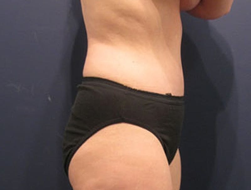 Tummy Tuck Before & After