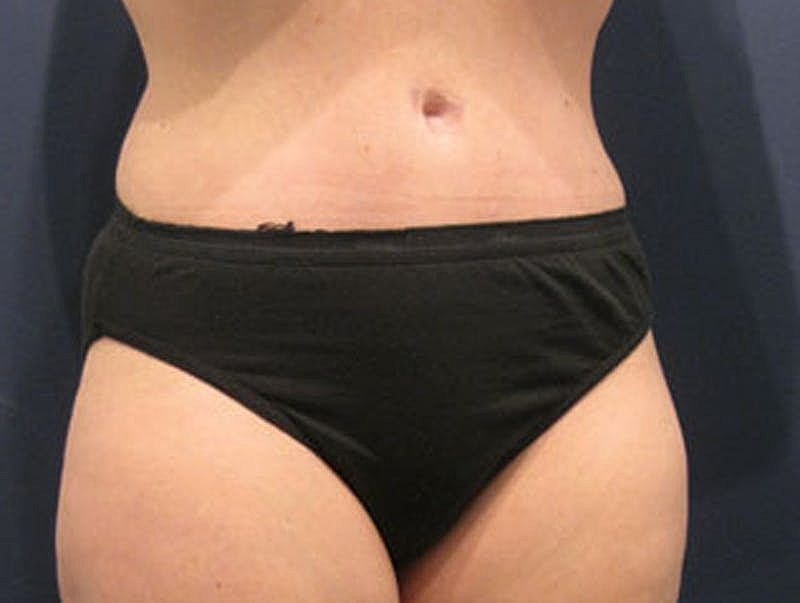 Tummy Tuck Before & After