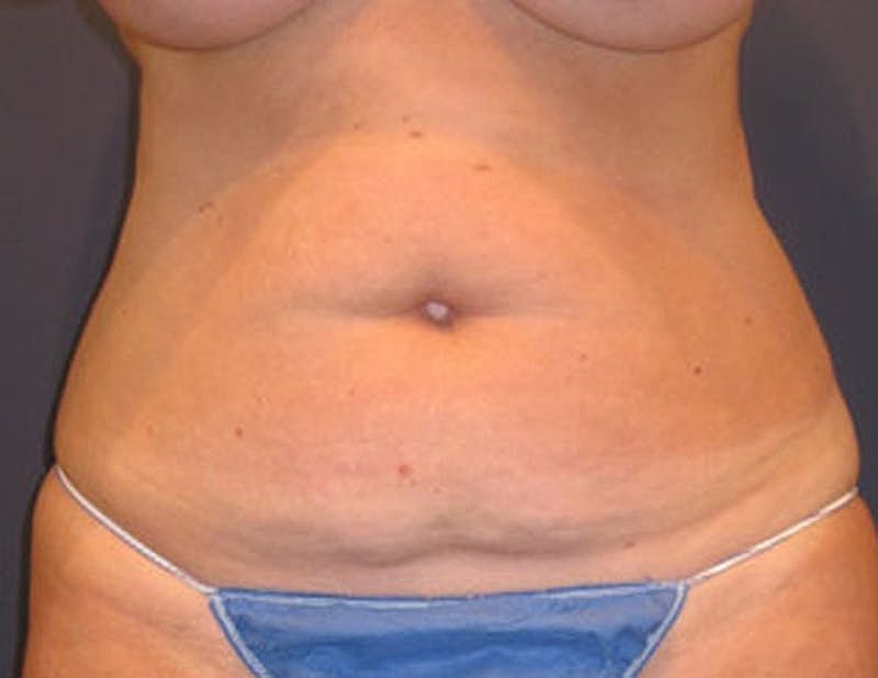 Tummy Tuck Before & After
