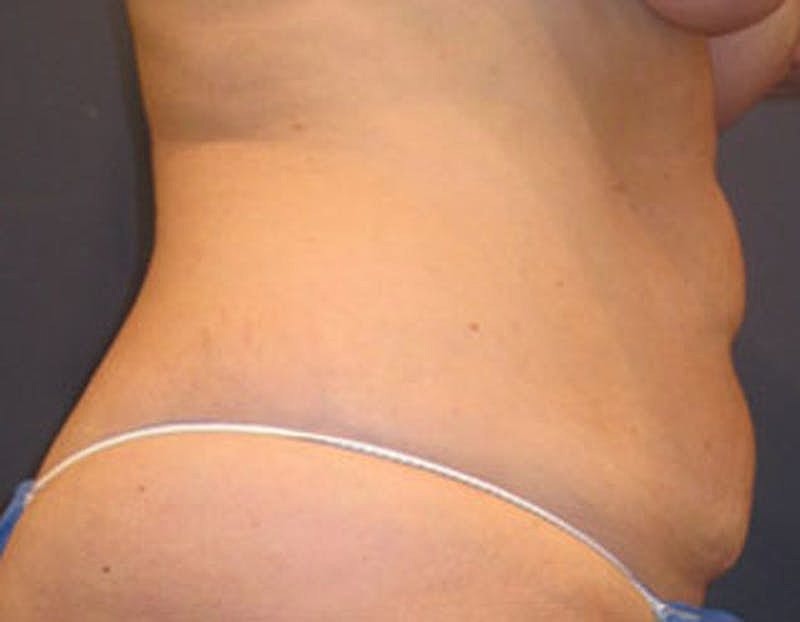 Tummy Tuck Before & After