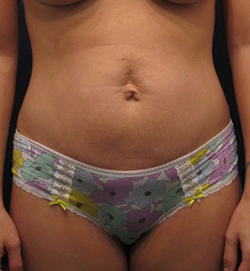 Tummy Tuck Before & After