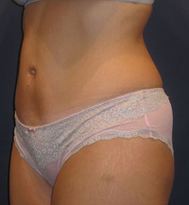 Tummy Tuck Before & After