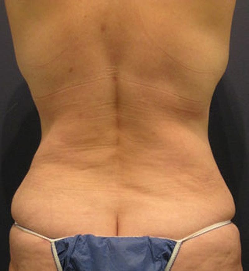 Tummy Tuck Before & After