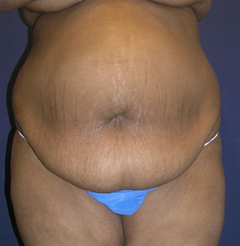 Tummy Tuck Before & After