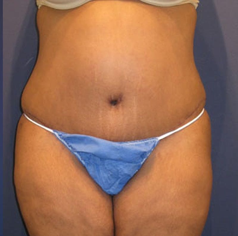 Tummy Tuck Before & After