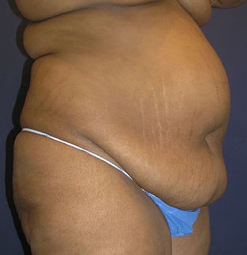 Tummy Tuck Before & After