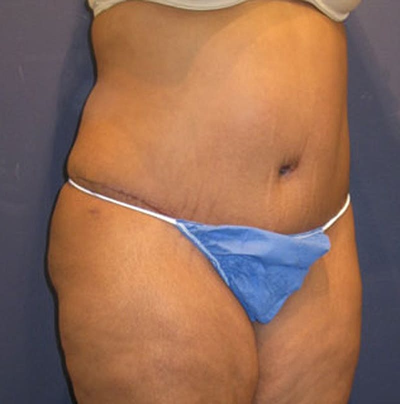Tummy Tuck Before & After