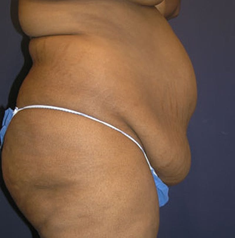 Tummy Tuck Before & After