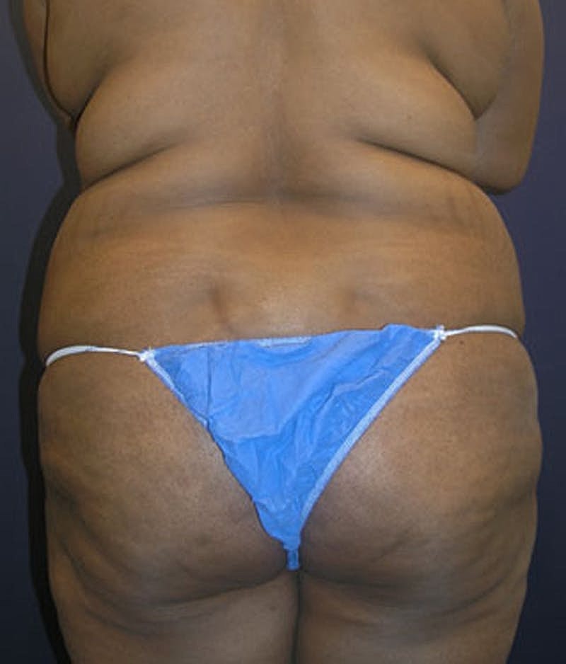 Tummy Tuck Before & After