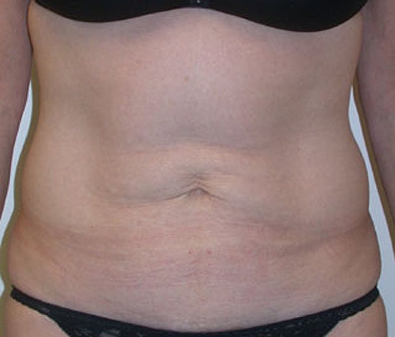 Tummy Tuck Before & After