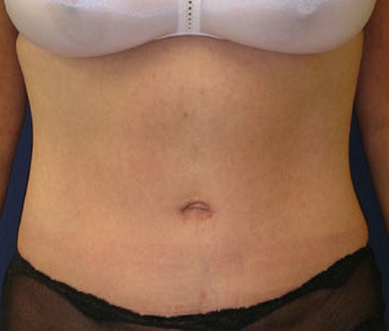 Tummy Tuck Before & After