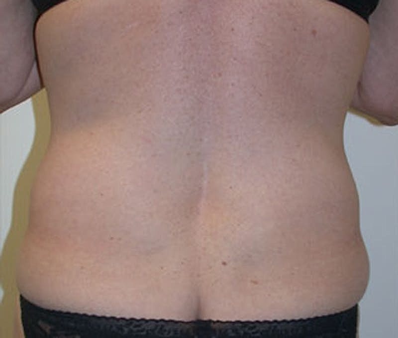 Tummy Tuck Before & After